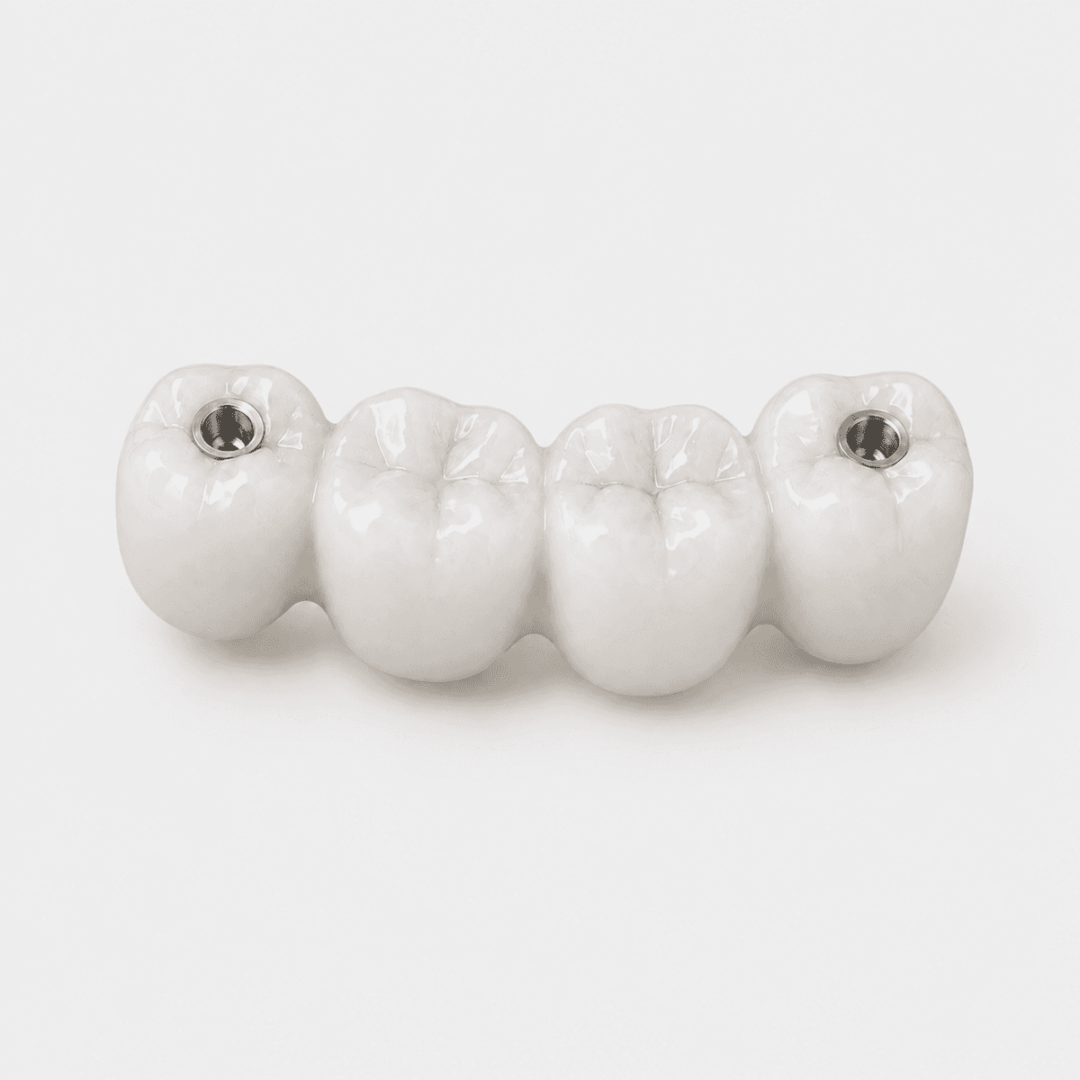 Screw-Retained Bridge